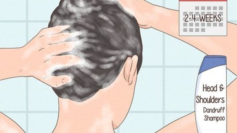 How to Prevent and Treat Dandruff