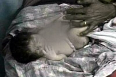 Jaipur: Baby born with heart outside her body
