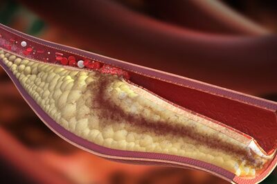 Why Leg Pain Can Be A Sign Of High Cholesterol