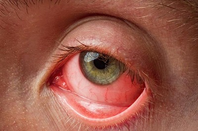 Eye Flu: Know the Causes, Symptoms, Types and Remedies