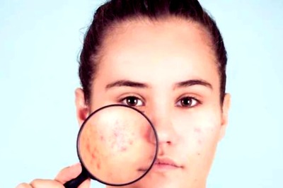 Dermatologist Explains What Causes Acne, and How We Address The Issue