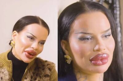 Man Opts For Botox Over Facials To Address Crow's Feet And  Brow Lines, Says 'It Is More Affordable'