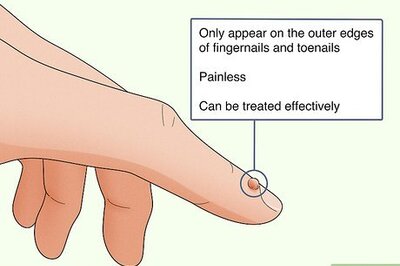 Periungual Warts: Symptoms, Treatment, and Prevention