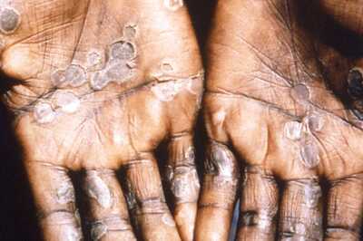 Can Monkeypox Cause Covid-like Pandemic? Top US Doctor Lists 5 Reasons Why Not to Worry