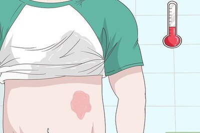 How to Treat an Ice Burn