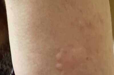 Man Gets Bitten By Bugs While Watching 'Oppenheimer' At PVR Chennai, Multiplex Chain Responds