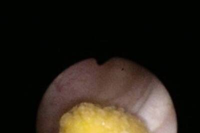 Stones Removed from 3-year-old Boy's Urinary Bladder in Hyderabad