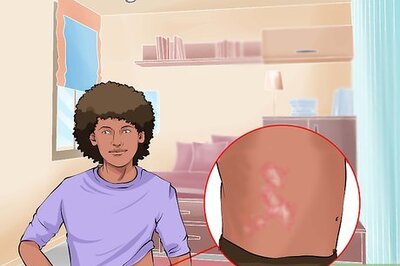 How to Identify and Treat Ringworm