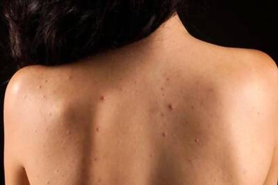 Struggling With Back Acne? 7 Tips To Treat Them