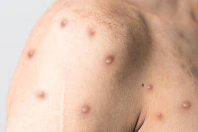 Monkeypox: Second Nigerian National With No Foreign Travel History Tests Positive in Delhi