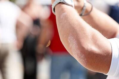 Summer Skincare: Four Tips For Managing Eczema in The Sun