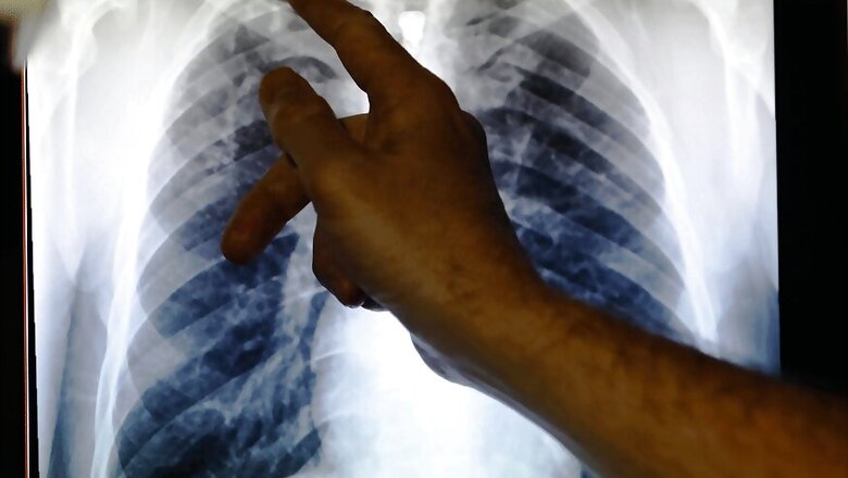 India's Draft Strategy to Eliminate TB Seems More Smoke Than Fire
