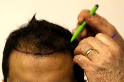 Mumbai Businessman Dies 50 Hours After Getting 12-hour Hair Transplant