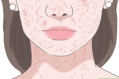 How to Treat a Heat Rash on Your Face