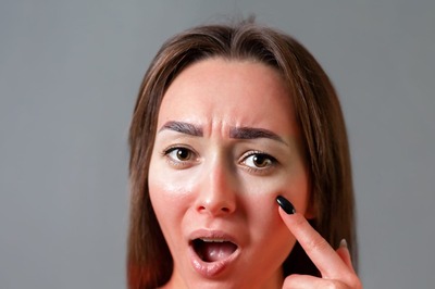 Beauty Guide: Helpful Skincare Tips to Treat Skin Burns