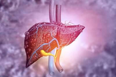 Excess Sugar Consumption Can Cause Fatty Liver; Here's All You Need to Know