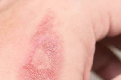 Avoid These Mistakes While Treating Burns
