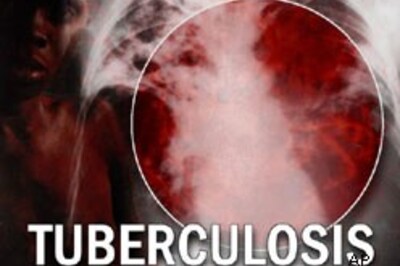 Vitamin D may help fight tuberculosis