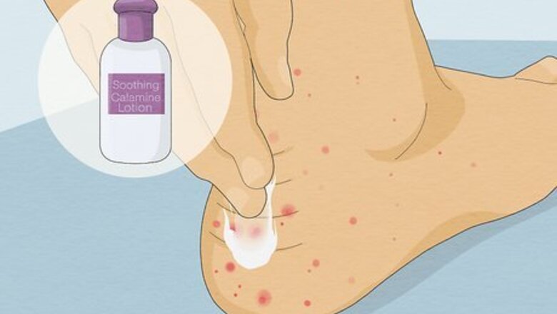 Sand Flea Bites: Treatment, Prevention, & More