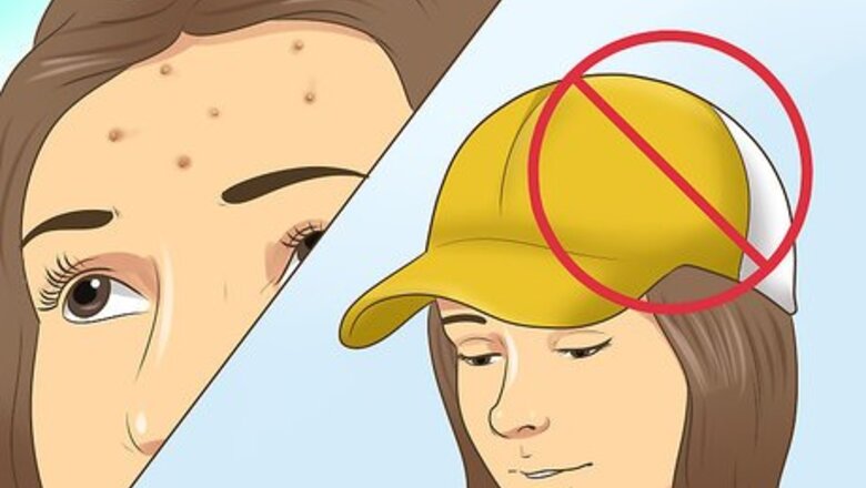 How to Stop Getting Acne in the Same Spot