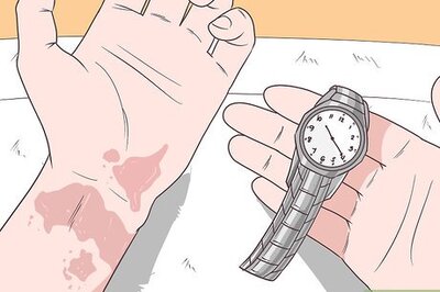 How to Treat Apple Cider Vinegar Burns