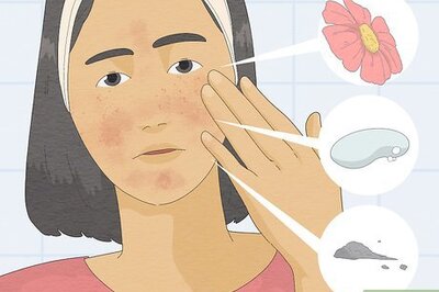 How to Treat Face Eczema