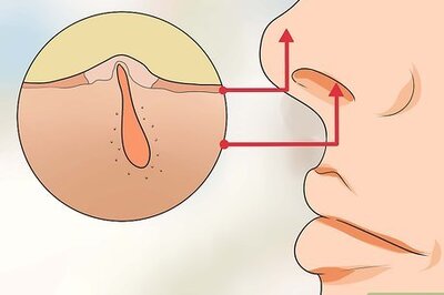How to Treat Ingrown Nose Hairs