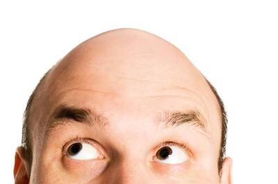 Short, Fair Men More at Risk of Premature Hair Loss
