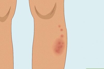 How to Treat Poison Ivy Rashes at Home