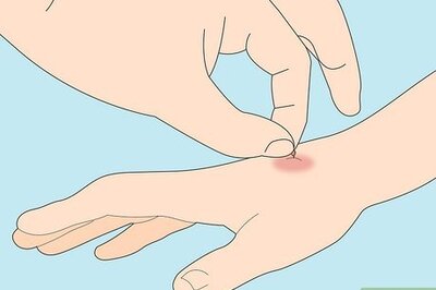 How to Treat a Wasp or Hornet Sting