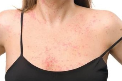 How To Safely And Effectively Sunbathe For Psoriasis Treatment