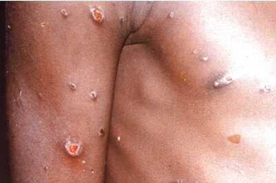 Monkeypox Scare: Gay, Bisexual Men Cautioned As Experts Try to Understand The New Virus