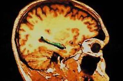 Drug that may help schizophrenics think